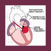 endocarditis image healthtips images